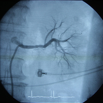 Experto en Manejo de la Enfermedad Tromboembólica Venosa y la Anticoagulación en la Fibrilación Auricular