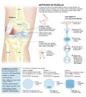 Células madre de la médula ósea para el tratamiento de la artrosis de rodilla